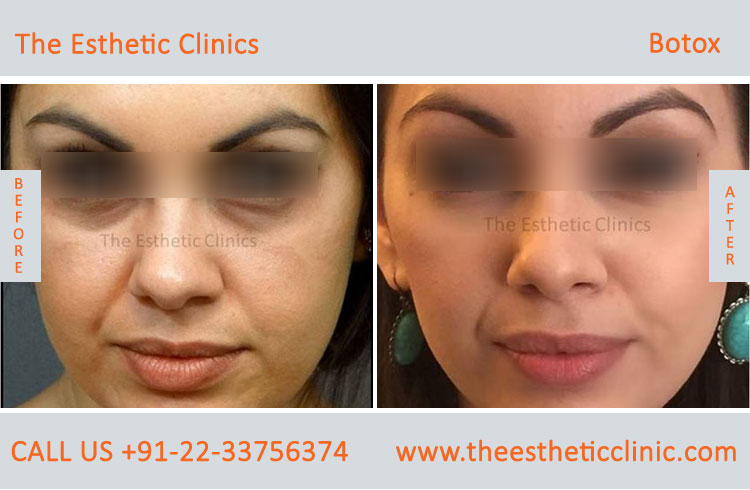 botox treatment for face wrinkles before after photos in mumbai india (9)